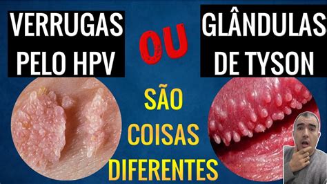 glandulas de tyson ou hpv|Glândulas de Tyson: o que é, causas e sintomas